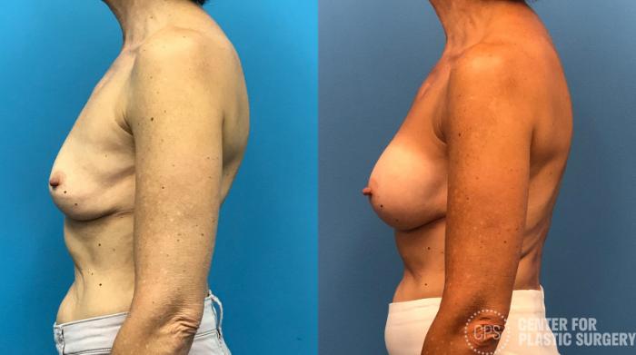 Revision Augmentation Case 175 Before & After Left Side | Chevy Chase & Annandale, Washington D.C. Metropolitan Area | Center for Plastic Surgery