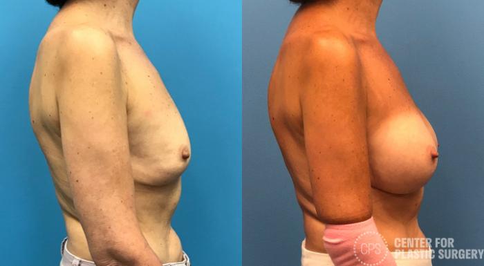 Revision Augmentation Case 175 Before & After Right Side | Chevy Chase & Annandale, Washington D.C. Metropolitan Area | Center for Plastic Surgery