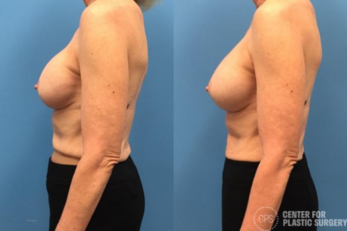 Revision Augmentation Case 237 Before & After Left Side | Chevy Chase & Annandale, Washington D.C. Metropolitan Area | Center for Plastic Surgery