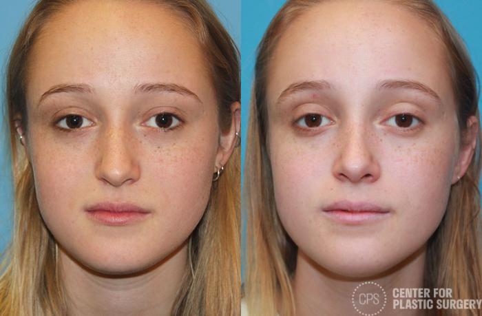 Rhinoplasty Case 23 Before & After Front | Chevy Chase & Annandale, Washington D.C. Metropolitan Area | Center for Plastic Surgery