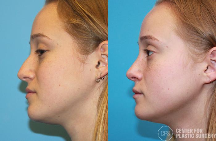 Rhinoplasty Case 23 Before & After Left Side | Chevy Chase & Annandale, Washington D.C. Metropolitan Area | Center for Plastic Surgery