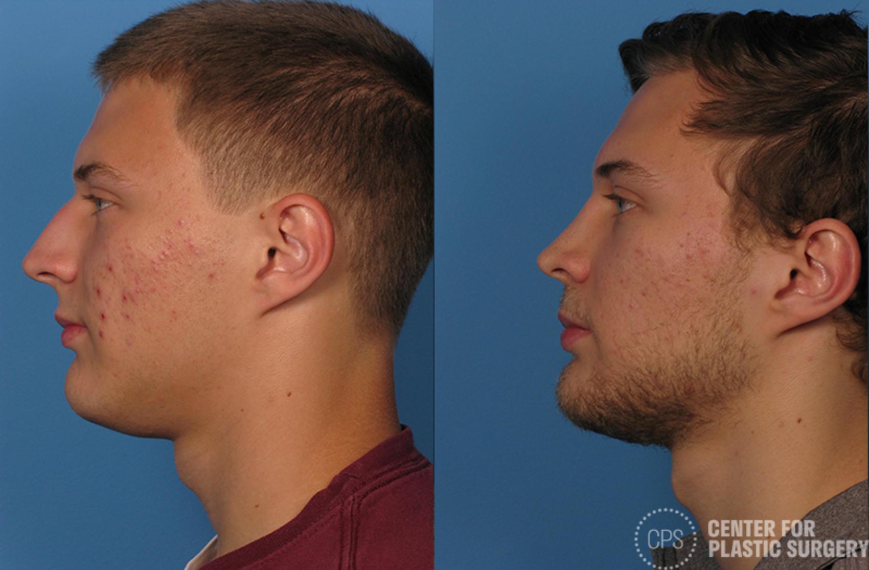 Rhinoplasty Case 24 Before & After Left Side | Annandale, Washington D.C. Metropolitan Area | Center for Plastic Surgery