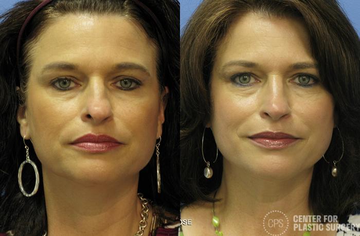 Rhinoplasty Case 25 Before & After Front | Chevy Chase & Annandale, Washington D.C. Metropolitan Area | Center for Plastic Surgery