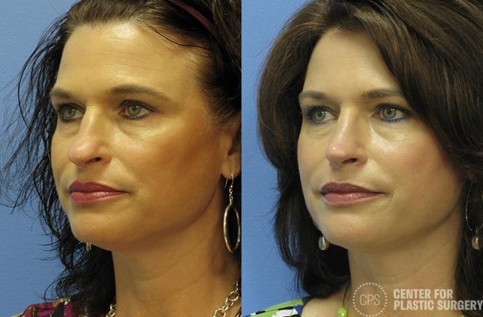 Rhinoplasty Case 25 Before & After Left Oblique | Chevy Chase & Annandale, Washington D.C. Metropolitan Area | Center for Plastic Surgery