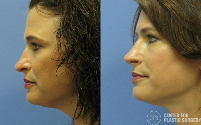 Rhinoplasty Case 25 Before & After Left Side | Chevy Chase & Annandale, Washington D.C. Metropolitan Area | Center for Plastic Surgery