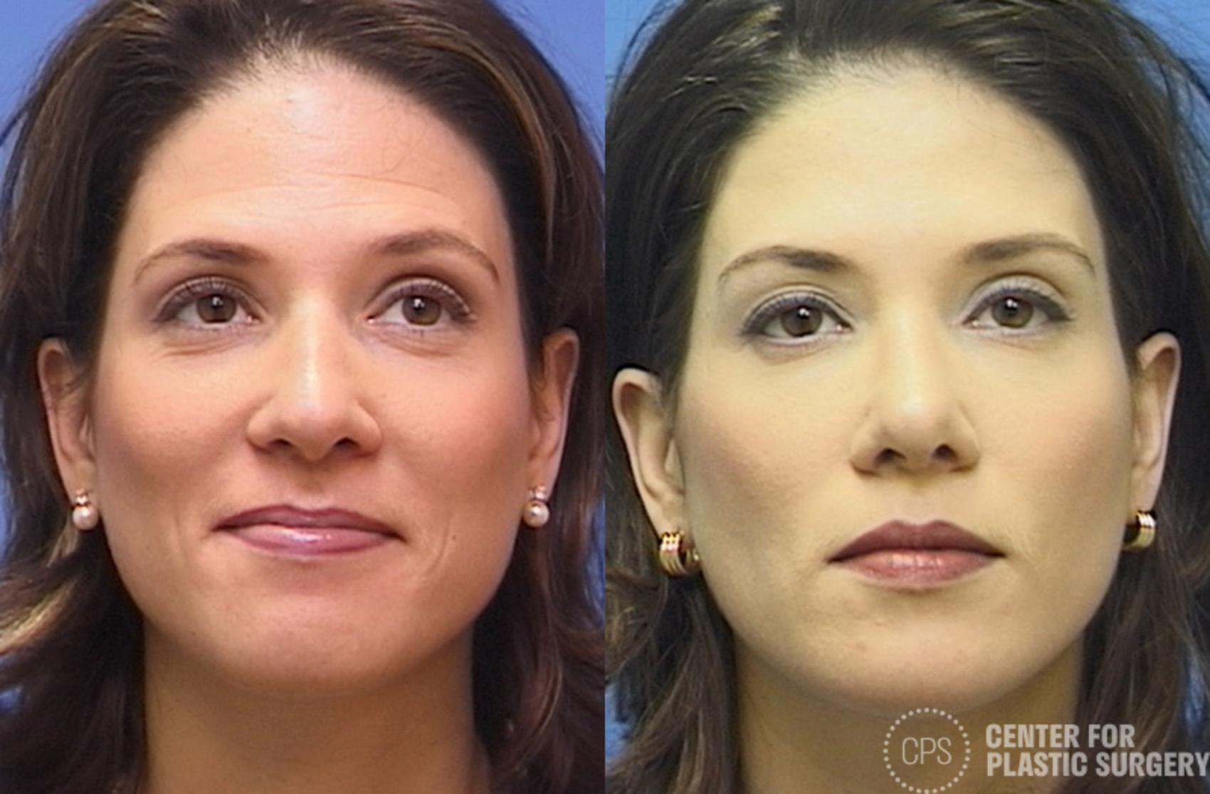 Rhinoplasty Case 26 Before & After Front | Annandale, Washington D.C. Metropolitan Area | Center for Plastic Surgery