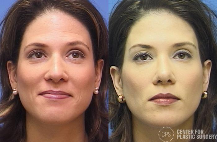 Rhinoplasty Case 26 Before & After Front | Chevy Chase & Annandale, Washington D.C. Metropolitan Area | Center for Plastic Surgery