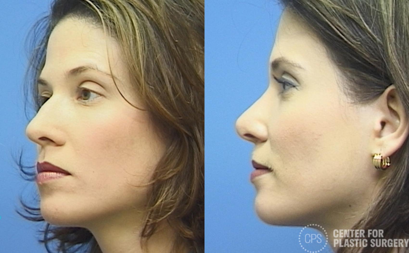 Rhinoplasty Case 26 Before & After Left Oblique | Chevy Chase & Annandale, Washington D.C. Metropolitan Area | Center for Plastic Surgery