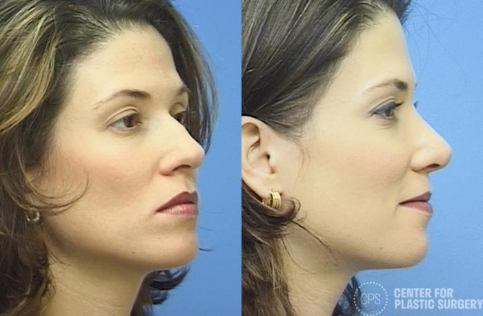 Rhinoplasty Case 26 Before & After Right Oblique | Chevy Chase & Annandale, Washington D.C. Metropolitan Area | Center for Plastic Surgery