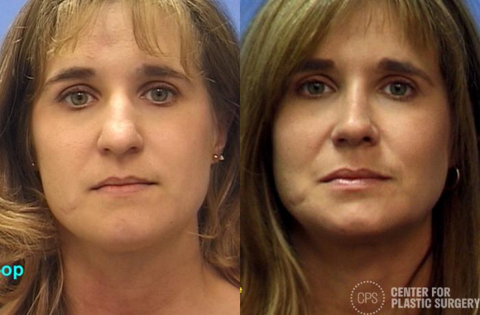 Rhinoplasty Case 27 Before & After Front | Chevy Chase & Annandale, Washington D.C. Metropolitan Area | Center for Plastic Surgery