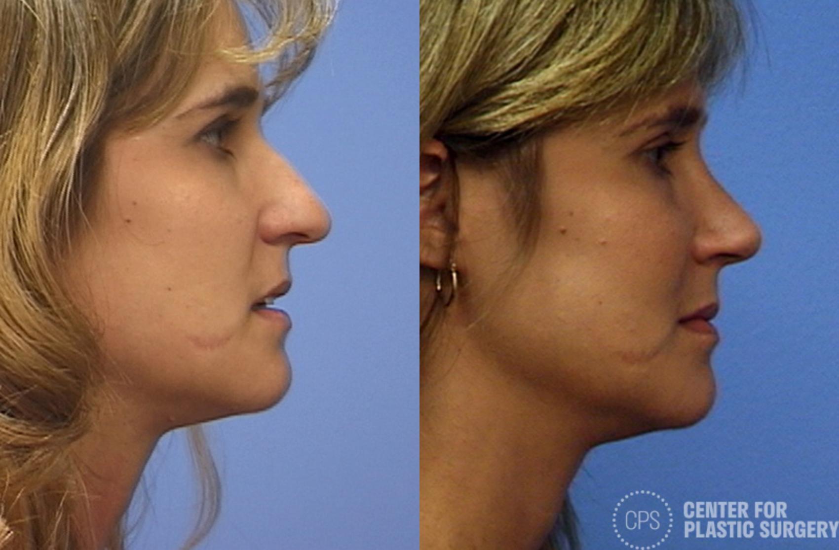 Rhinoplasty Case 27 Before & After Right Side | Annandale, Washington D.C. Metropolitan Area | Center for Plastic Surgery