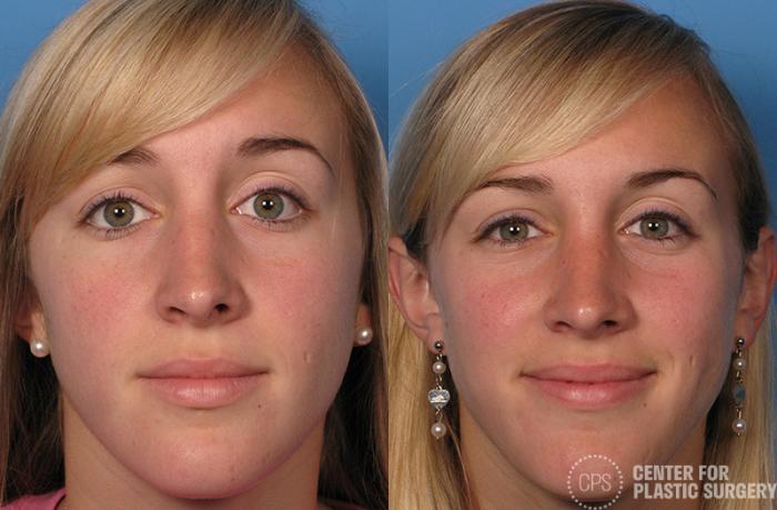 Rhinoplasty Case 29 Before & After Front | Chevy Chase & Annandale, Washington D.C. Metropolitan Area | Center for Plastic Surgery