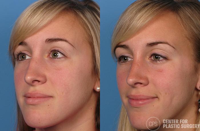 Rhinoplasty Case 29 Before & After Left Oblique | Chevy Chase & Annandale, Washington D.C. Metropolitan Area | Center for Plastic Surgery