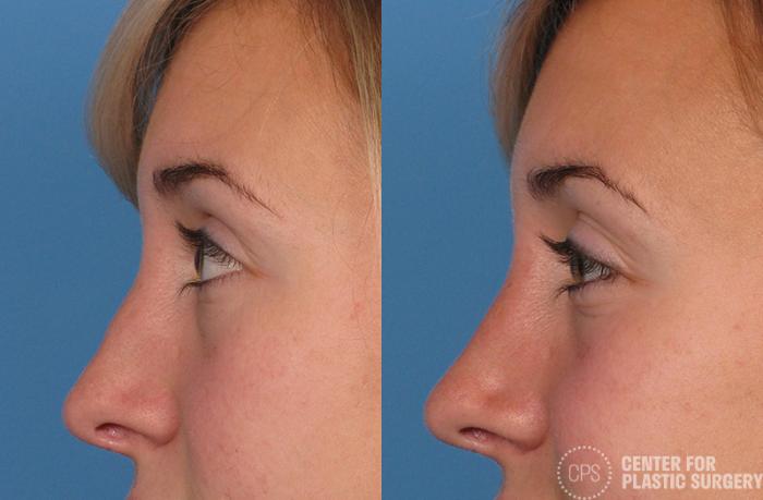 Rhinoplasty Case 29 Before & After Left Side | Chevy Chase & Annandale, Washington D.C. Metropolitan Area | Center for Plastic Surgery