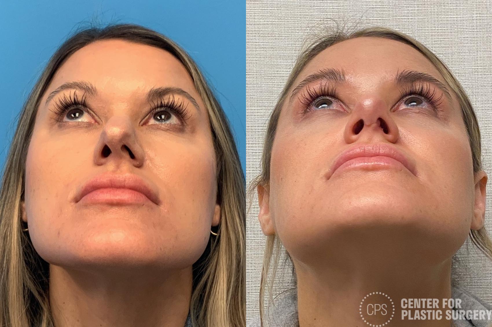 Rhinoplasty Case 319 Before & After Basal | Chevy Chase & Annandale, Washington D.C. Metropolitan Area | Center for Plastic Surgery
