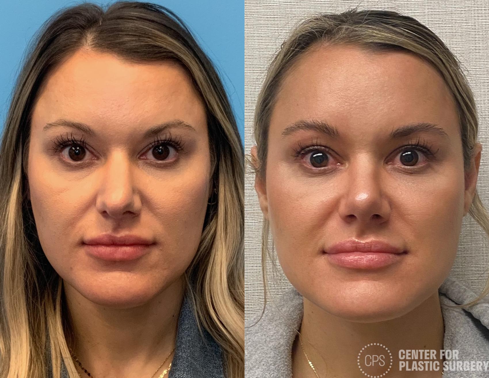 Rhinoplasty Case 319 Before & After Front | Chevy Chase & Annandale, Washington D.C. Metropolitan Area | Center for Plastic Surgery