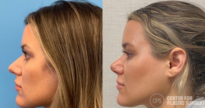 Rhinoplasty Case 319 Before & After Left Side | Chevy Chase & Annandale, Washington D.C. Metropolitan Area | Center for Plastic Surgery