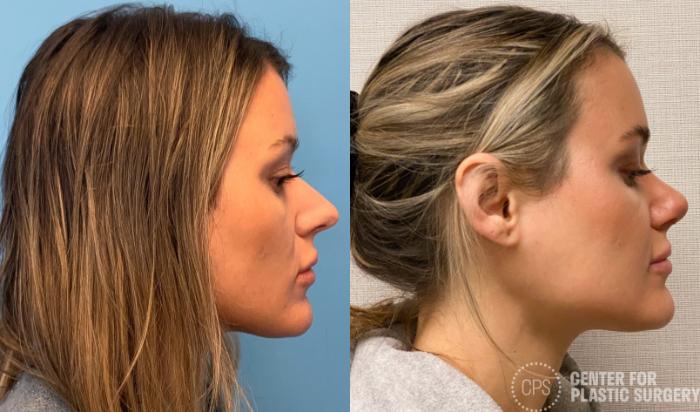 Rhinoplasty Case 319 Before & After Right Side | Chevy Chase & Annandale, Washington D.C. Metropolitan Area | Center for Plastic Surgery