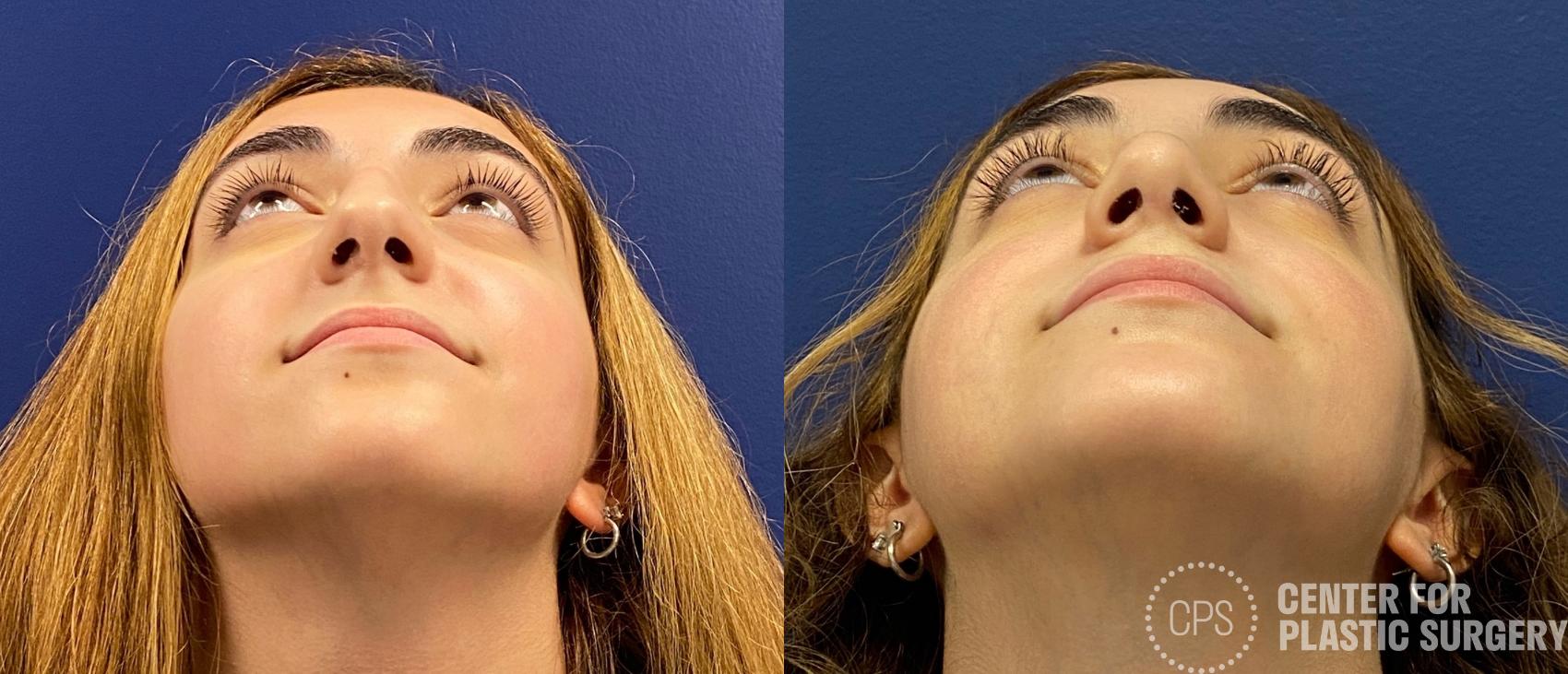 Rhinoplasty Case 320 Before & After Basal | Chevy Chase & Annandale, Washington D.C. Metropolitan Area | Center for Plastic Surgery