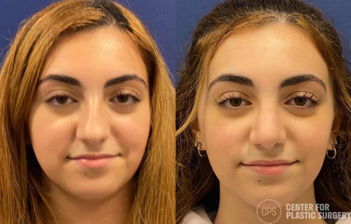 Rhinoplasty Case 320 Before & After Front | Chevy Chase & Annandale, Washington D.C. Metropolitan Area | Center for Plastic Surgery