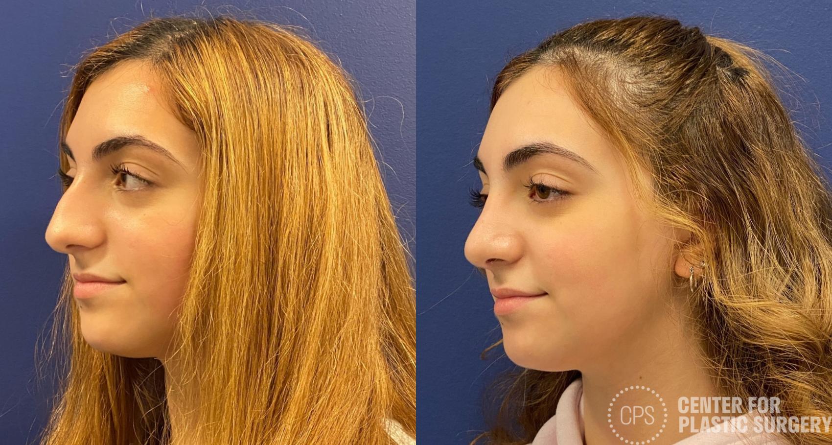Rhinoplasty Case 320 Before & After Left Oblique | Chevy Chase & Annandale, Washington D.C. Metropolitan Area | Center for Plastic Surgery