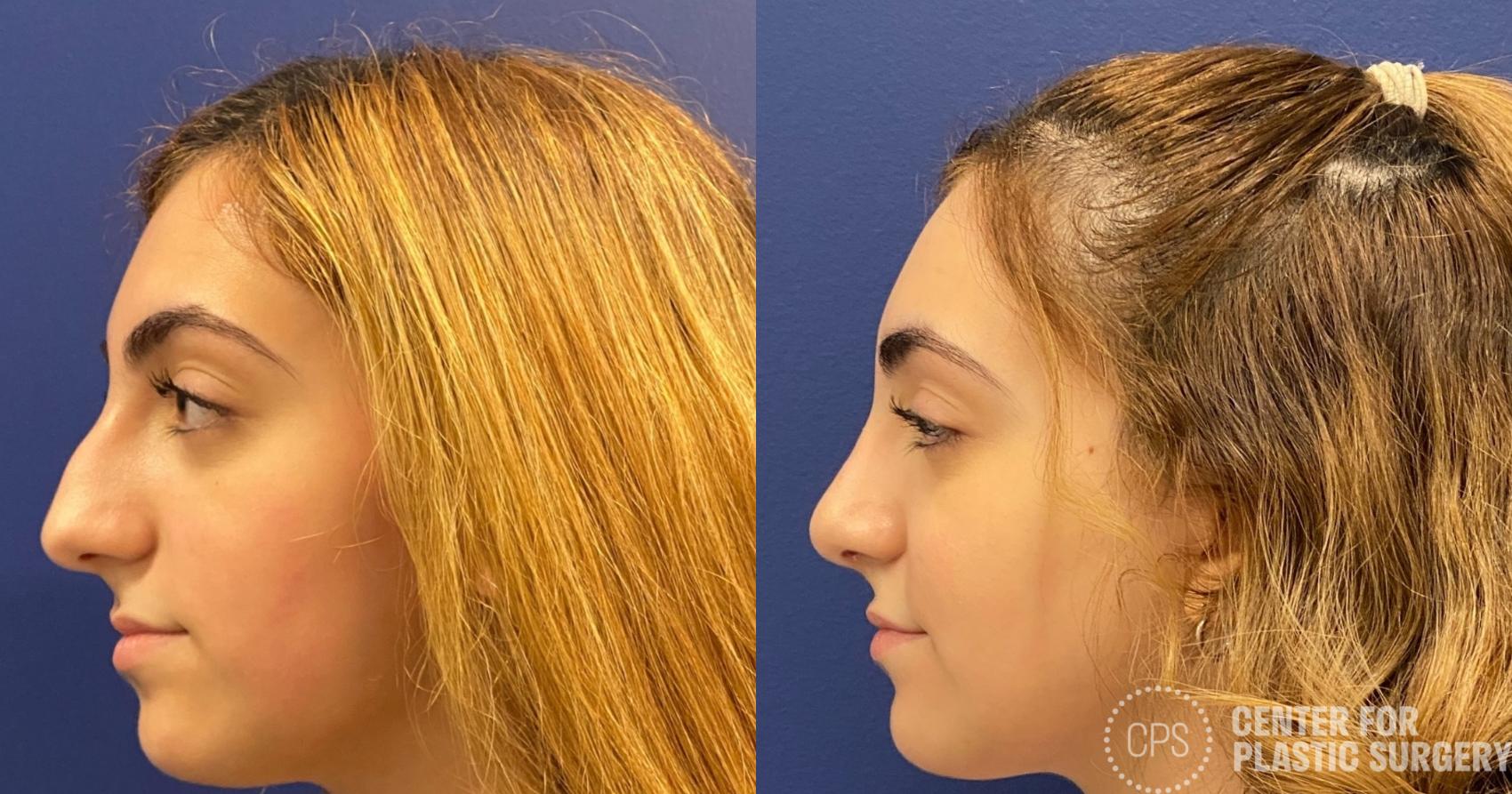 Rhinoplasty Case 320 Before & After Left Side | Chevy Chase & Annandale, Washington D.C. Metropolitan Area | Center for Plastic Surgery