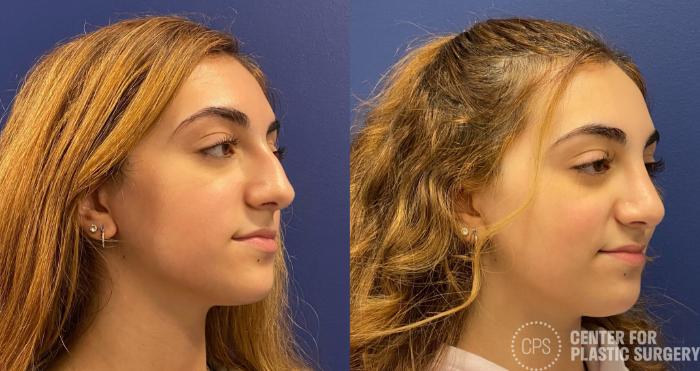 Rhinoplasty Case 320 Before & After Right Oblique | Chevy Chase & Annandale, Washington D.C. Metropolitan Area | Center for Plastic Surgery