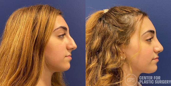 Rhinoplasty Case 320 Before & After Right Side | Chevy Chase & Annandale, Washington D.C. Metropolitan Area | Center for Plastic Surgery