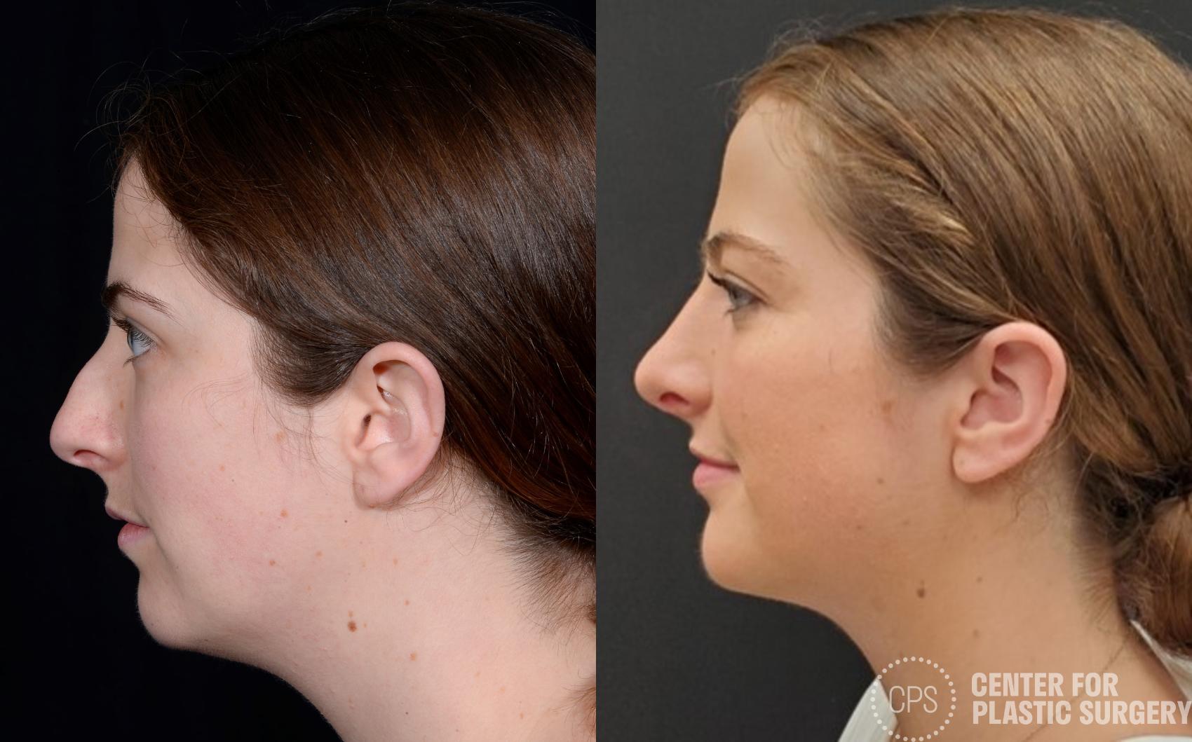 Rhinoplasty Case 373 Before & After Left Side | Annandale, Washington D.C. Metropolitan Area | Center for Plastic Surgery