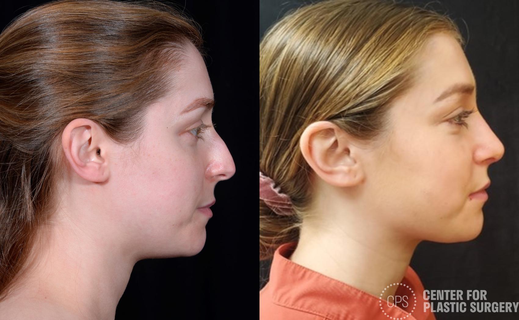 Rhinoplasty Case 374 Before & After Right Side | Chevy Chase & Annandale, Washington D.C. Metropolitan Area | Center for Plastic Surgery