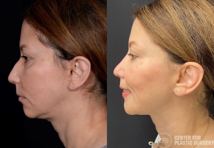 Rhinoplasty Case 375 Before & After Left Side | Chevy Chase & Annandale, Washington D.C. Metropolitan Area | Center for Plastic Surgery
