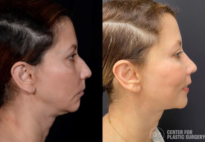 Rhinoplasty Case 375 Before & After Right Side | Chevy Chase & Annandale, Washington D.C. Metropolitan Area | Center for Plastic Surgery