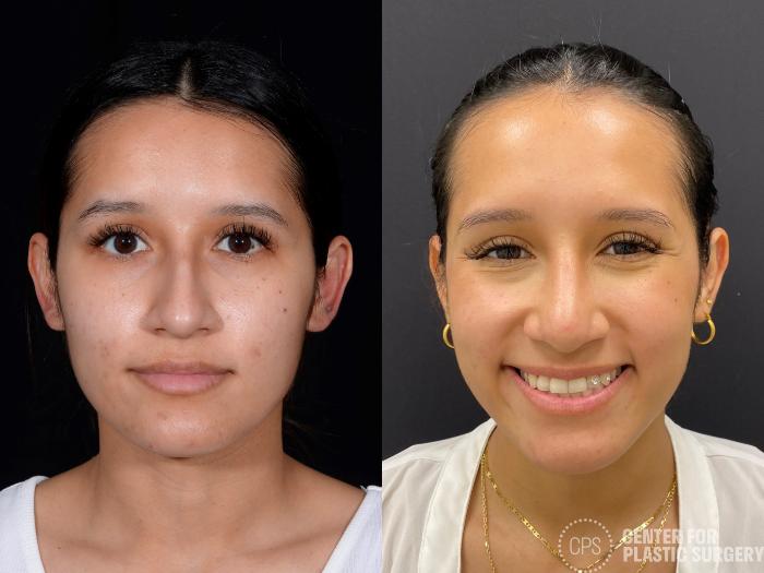Rhinoplasty Case 376 Before & After Front | Chevy Chase & Annandale, Washington D.C. Metropolitan Area | Center for Plastic Surgery