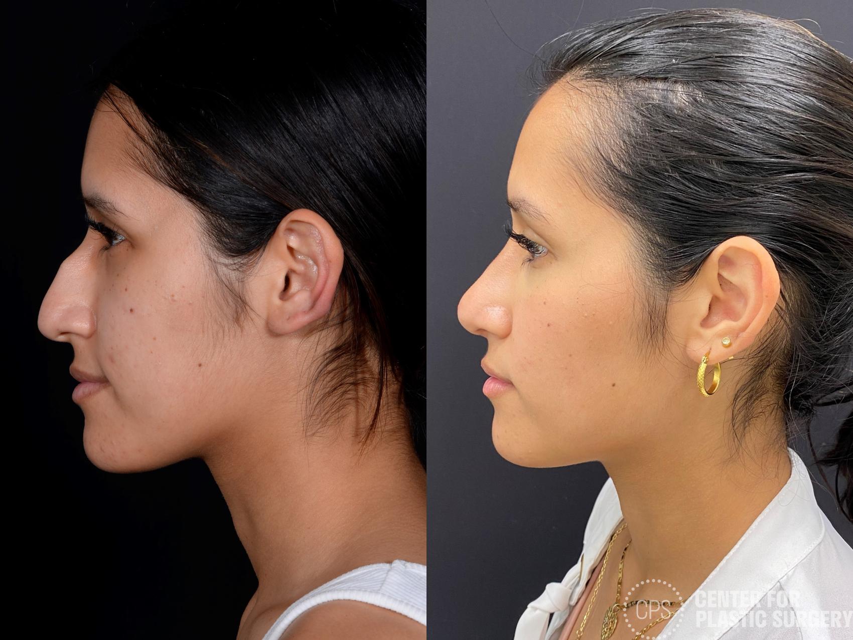 Rhinoplasty Case 376 Before & After Left Side | Chevy Chase & Annandale, Washington D.C. Metropolitan Area | Center for Plastic Surgery