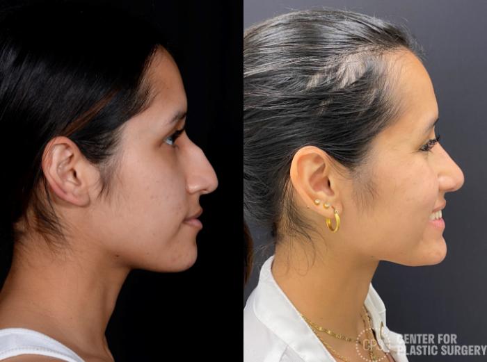 Rhinoplasty Case 376 Before & After Right Side | Chevy Chase & Annandale, Washington D.C. Metropolitan Area | Center for Plastic Surgery