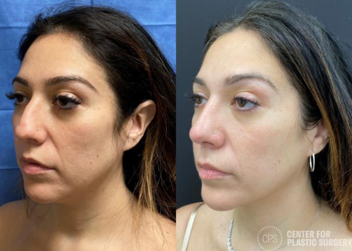 Rhinoplasty Case 377 Before & After Left Oblique | Chevy Chase & Annandale, Washington D.C. Metropolitan Area | Center for Plastic Surgery