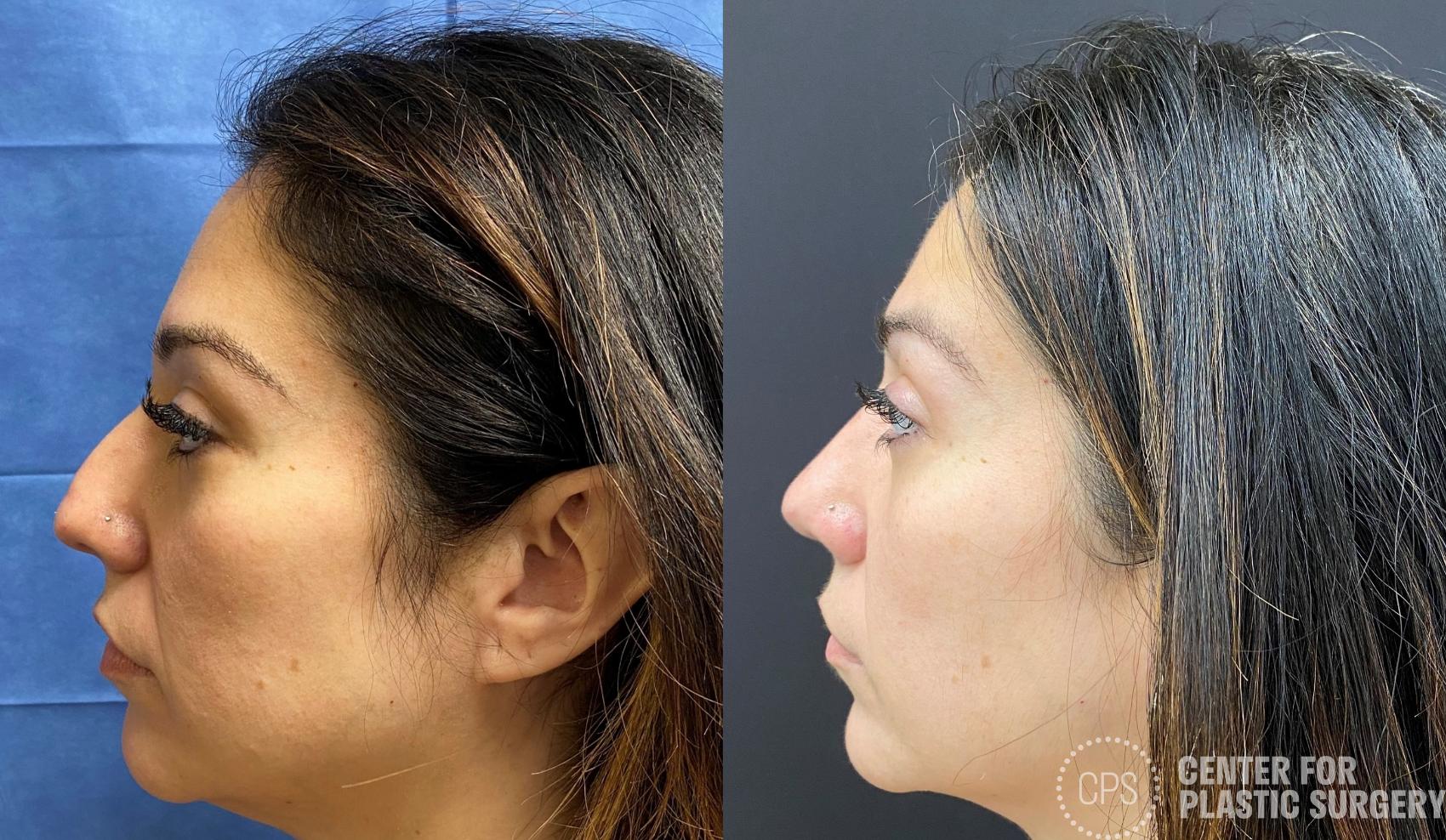 Rhinoplasty Case 377 Before & After Right Side | Chevy Chase & Annandale, Washington D.C. Metropolitan Area | Center for Plastic Surgery