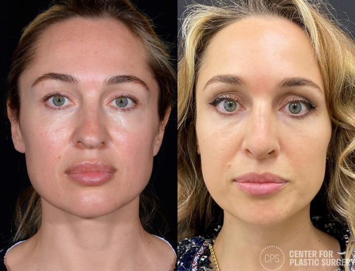 Rhinoplasty Case 378 Before & After Front | Chevy Chase & Annandale, Washington D.C. Metropolitan Area | Center for Plastic Surgery