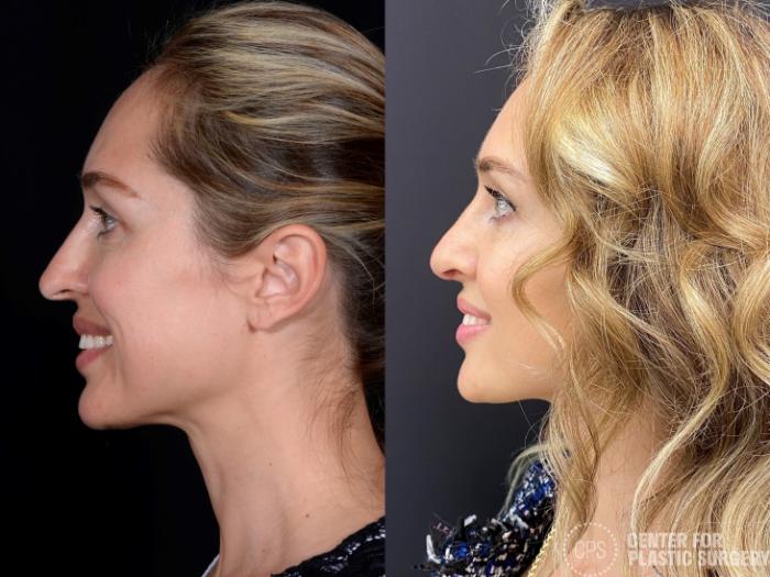 Rhinoplasty Before & After Photo Gallery