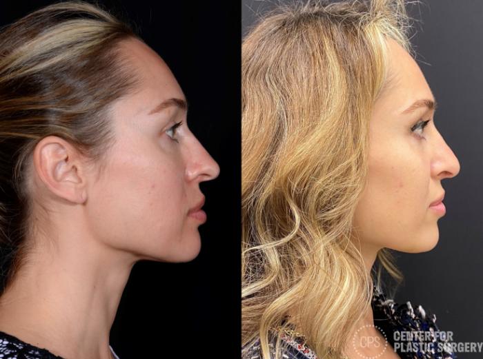 Rhinoplasty Case 378 Before & After Right Side | Chevy Chase & Annandale, Washington D.C. Metropolitan Area | Center for Plastic Surgery