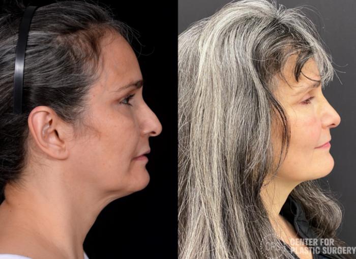 Rhinoplasty Case 380 Before & After Right Side | Chevy Chase & Annandale, Washington D.C. Metropolitan Area | Center for Plastic Surgery