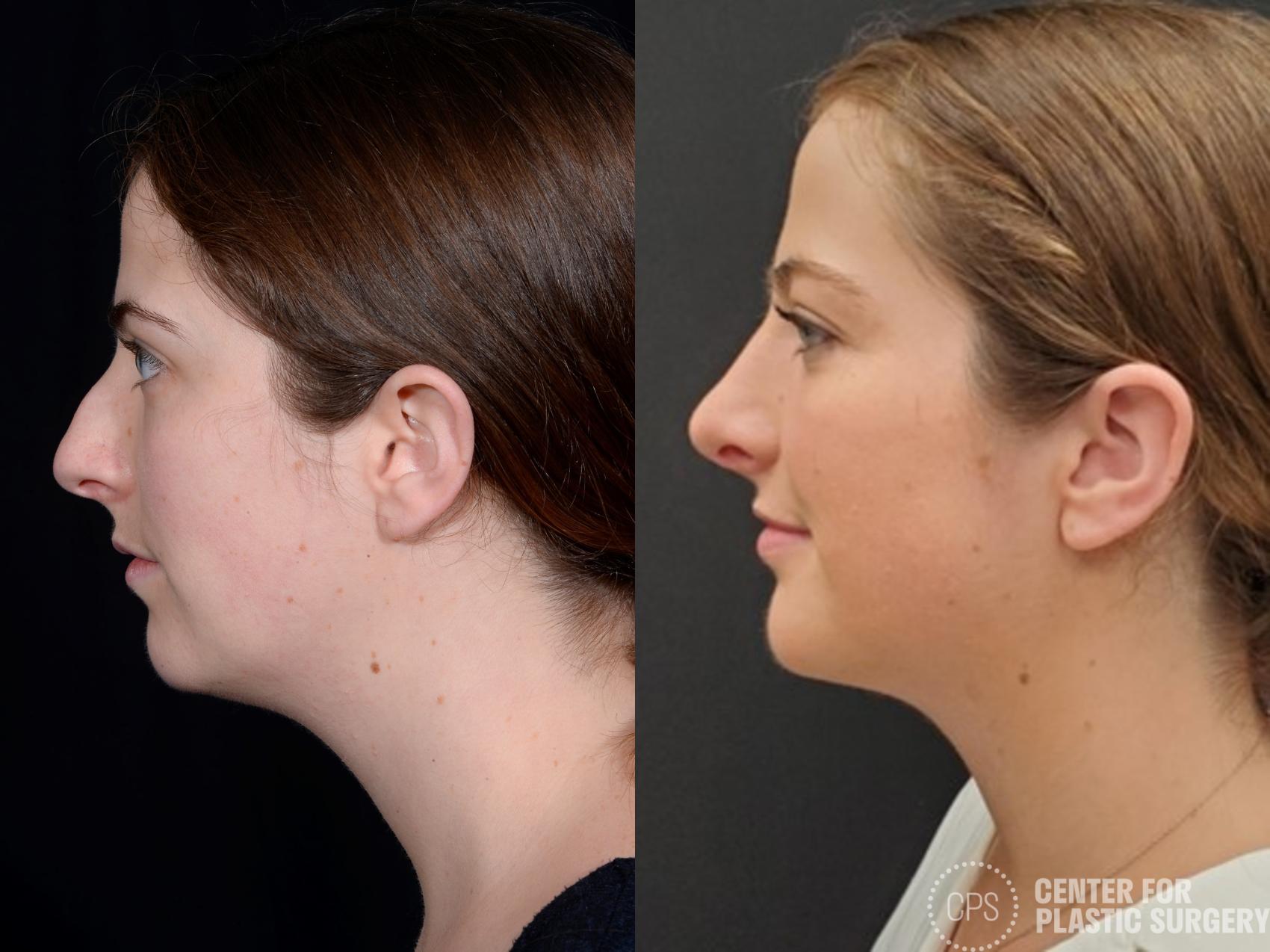 Rhinoplasty Case 381 Before & After Left Side | Chevy Chase & Annandale, Washington D.C. Metropolitan Area | Center for Plastic Surgery