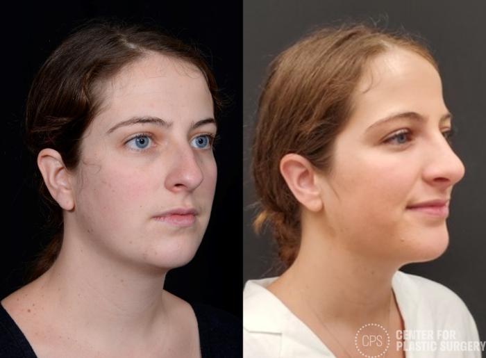 Rhinoplasty Case 381 Before & After Right Oblique | Chevy Chase & Annandale, Washington D.C. Metropolitan Area | Center for Plastic Surgery