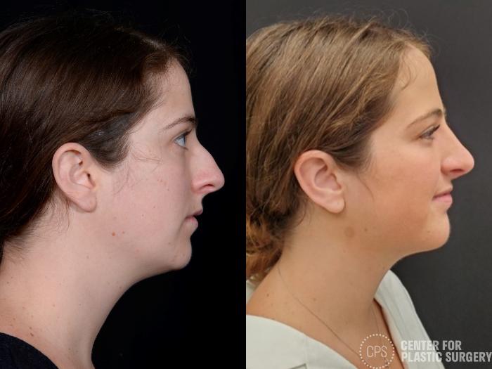 Rhinoplasty Case 381 Before & After Right Side | Chevy Chase & Annandale, Washington D.C. Metropolitan Area | Center for Plastic Surgery