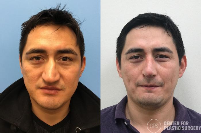 Rhinoplasty for Men Case 186 Before & After Front | Chevy Chase & Annandale, Washington D.C. Metropolitan Area | Center for Plastic Surgery