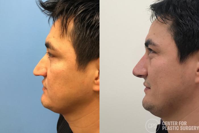 Rhinoplasty for Men Case 186 Before & After Right Side | Chevy Chase & Annandale, Washington D.C. Metropolitan Area | Center for Plastic Surgery