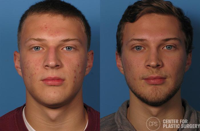 Rhinoplasty for Men Case 24 Before & After Front | Chevy Chase & Annandale, Washington D.C. Metropolitan Area | Center for Plastic Surgery