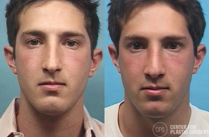 Rhinoplasty for Men Case 28 Before & After Front | Chevy Chase & Annandale, Washington D.C. Metropolitan Area | Center for Plastic Surgery