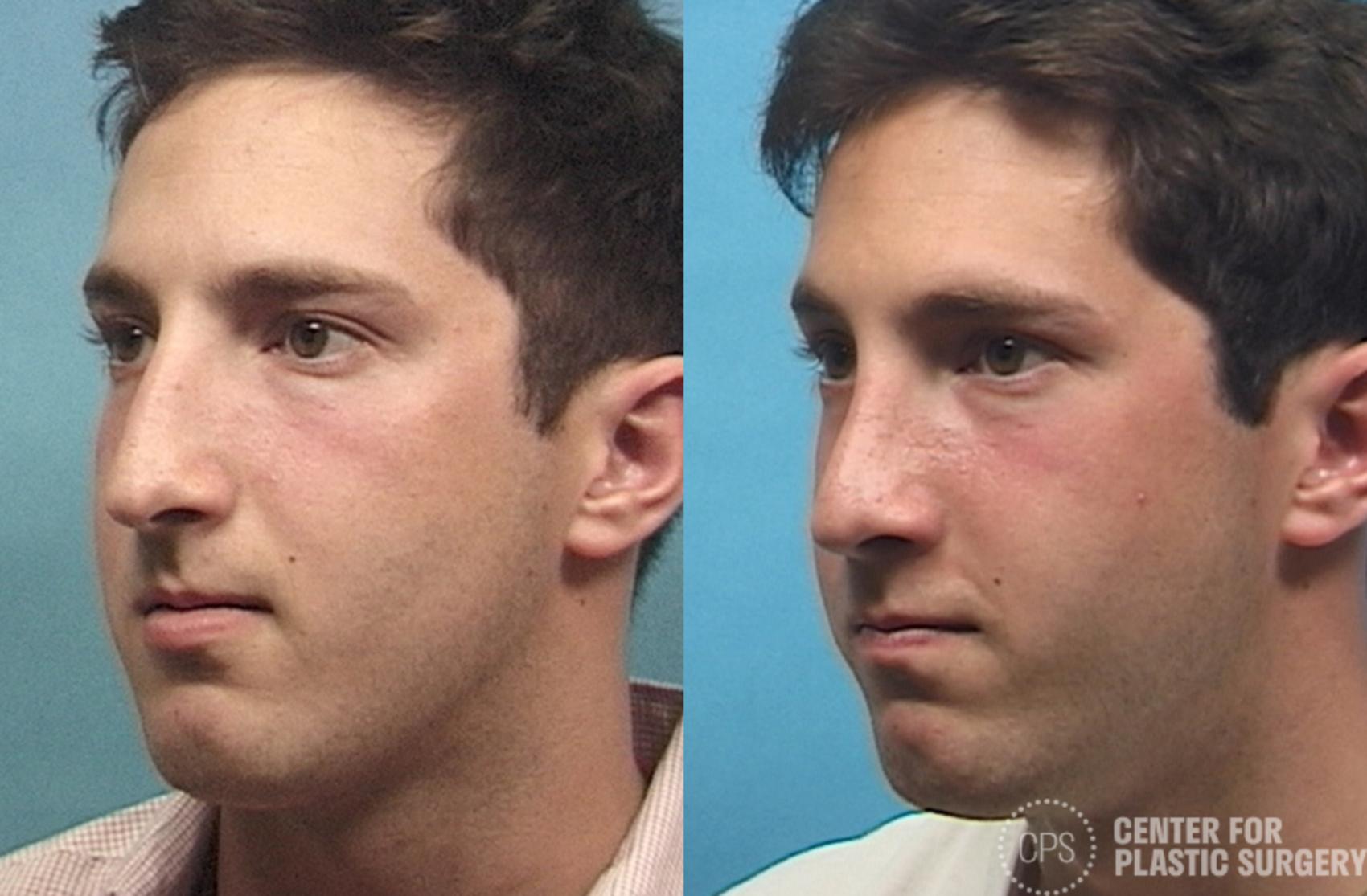 Rhinoplasty for Men Case 28 Before & After Left Oblique | Chevy Chase & Annandale, Washington D.C. Metropolitan Area | Center for Plastic Surgery