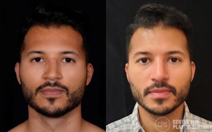 Rhinoplasty for Men Case 379 Before & After Front | Chevy Chase & Annandale, Washington D.C. Metropolitan Area | Center for Plastic Surgery